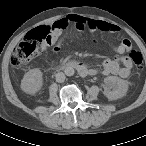 File:Acute pancreatitis and walled-off necrosis (Radiopaedia 29888-30403 Axial non-contrast 37).jpg