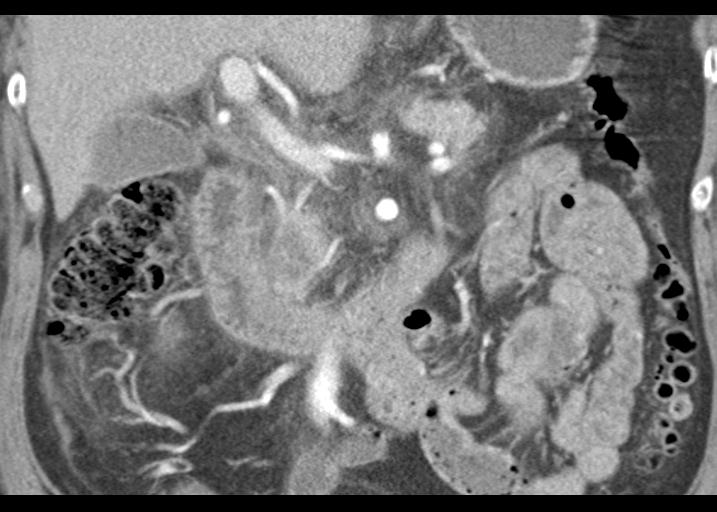 Acute pancreatitis and walled-off necrosis (Radiopaedia 29888-30403 Coronal C+ portal venous phase 28).jpg