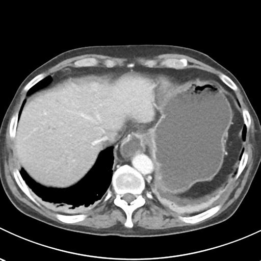 File:Acute pancreatitis and walled-off necrosis (Radiopaedia 29888-30404 Axial C+ portal venous phase 11).jpg
