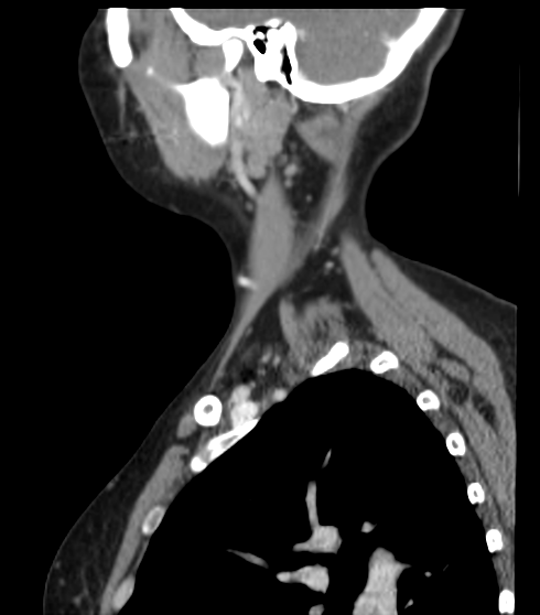 File:Acute parotitis (Radiopaedia 27425-27619 Sagittal C+ portal venous phase 45).png