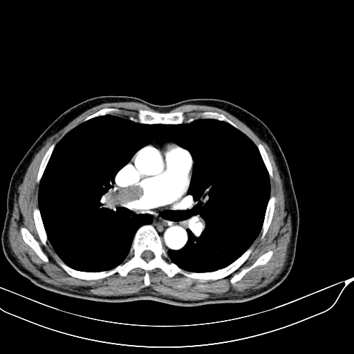 File:Acute pulmonary embolism (Radiopaedia 69510-79390 D 8).jpg