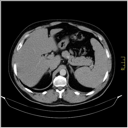 Acute right sided diverticulitis (Radiopaedia 65249-74268 Axial C+ portal venous phase 18).JPG