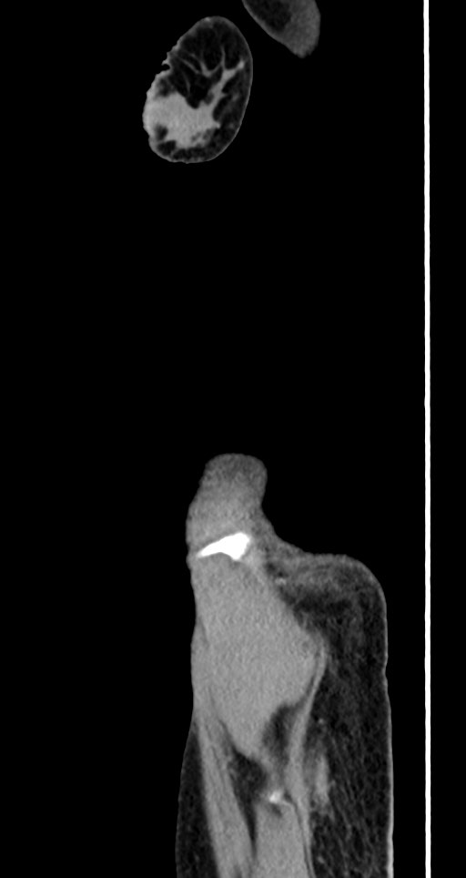 Acute small bowel (ileal) volvulus (Radiopaedia 71740-82139 Sagittal C+ portal venous phase 17).jpg