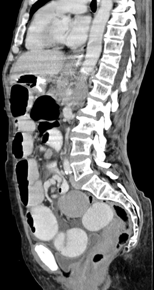 Acute small bowel (ileal) volvulus (Radiopaedia 71740-82139 Sagittal C+ portal venous phase 81).jpg