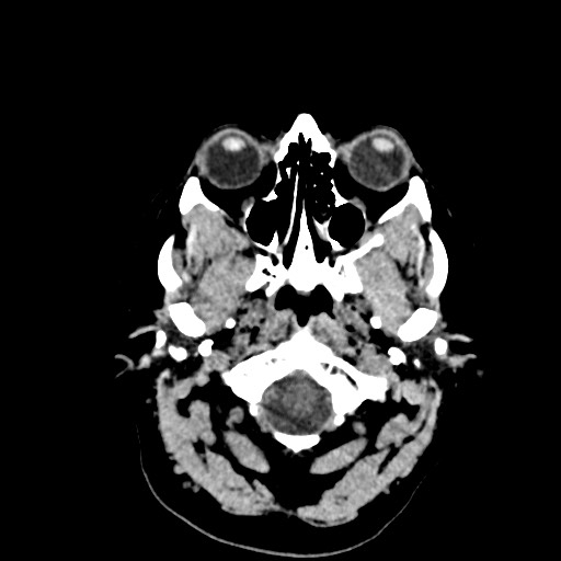 Acute subarachnoid hemorrhage and accessory anterior cerebral artery (Radiopaedia 69231-79008 Axial non-contrast 5).jpg