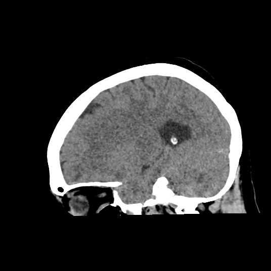 Acute subarachnoid hemorrhage and accessory anterior cerebral artery (Radiopaedia 69231-79008 Sagittal non-contrast 39).jpg