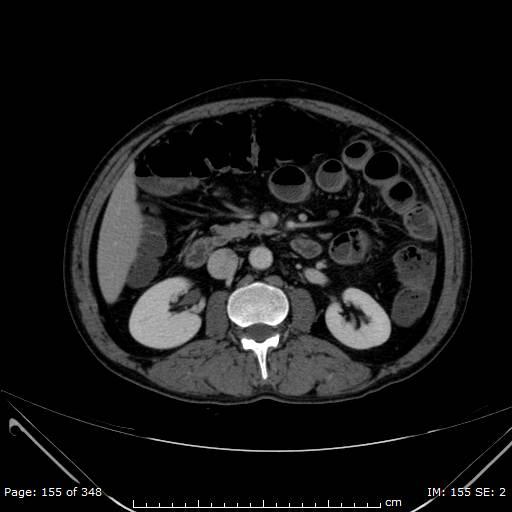 Acute superior mesenteric artery occlusion (Radiopaedia 43636-47060 Axial C+ portal venous phase 19).jpg