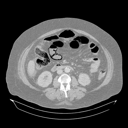Acute superior mesenteric artery occlusion (Radiopaedia 51288-56960 Axial lung window 30).jpg