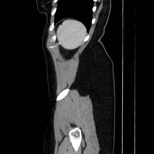 Acute uncomplicated appendicitis (Radiopaedia 73704-84499 Sagittal C+ portal venous phase 172).jpg