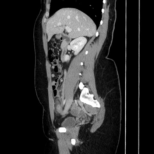 Acute uncomplicated appendicitis (Radiopaedia 73704-84499 Sagittal C+ portal venous phase 92).jpg