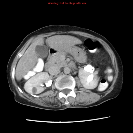 Adenocarcinoma of the colon (Radiopaedia 8191-9039 Axial renal excretory phase 15).jpg