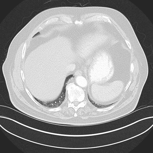 Adenocarcioma of rectum- T1 lesion (Radiopaedia 36921-38547 Axial lung window 45).png