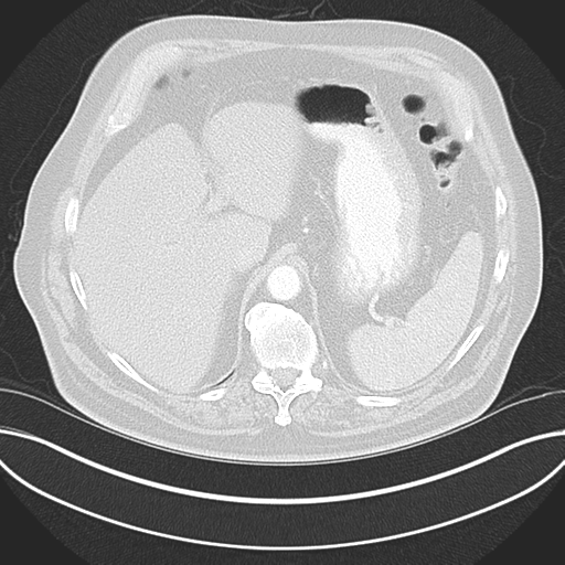 Adenocarcioma of rectum- T1 lesion (Radiopaedia 36921-38547 Axial lung window 52).png