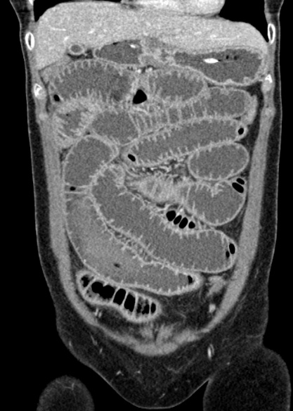 Adhesional small bowel obstruction (Radiopaedia 48397-53305 Coronal C+ portal venous phase 97).jpg