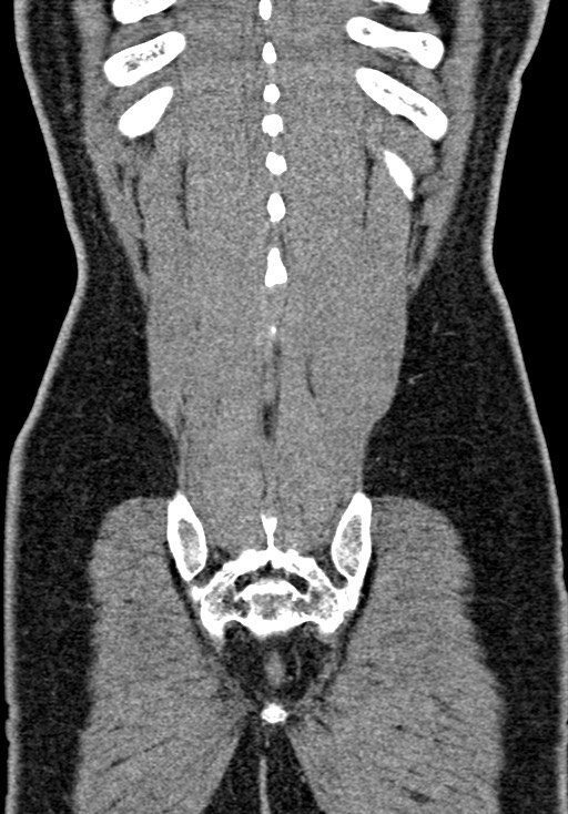 Adhesional small bowel obstruction (Radiopaedia 58900-66131 Coronal C+ portal venous phase 216).jpg