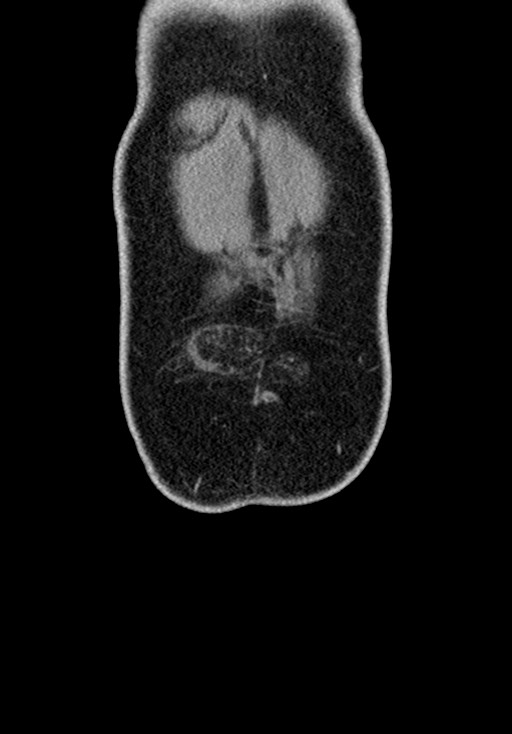 Adhesional small bowel obstruction (Radiopaedia 58900-66131 Coronal C+ portal venous phase 53).jpg