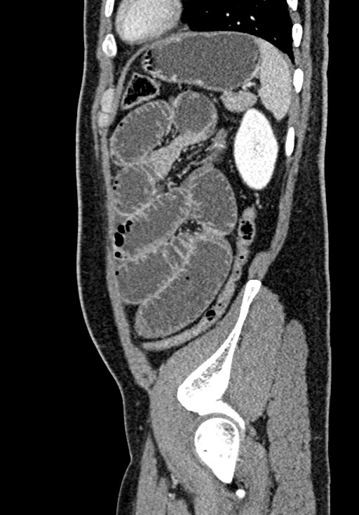 Adhesional small bowel obstruction (Radiopaedia 58900-66131 Sagittal C+ portal venous phase 200).jpg
