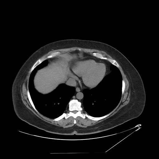 Adrenal angiosarcoma (Radiopaedia 81081-94671 Axial non-contrast 6).jpg