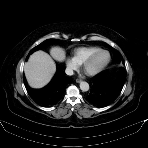 Adrenal cortical carcinoma (Radiopaedia 64017-72769 Axial C+ portal venous phase 4).jpg
