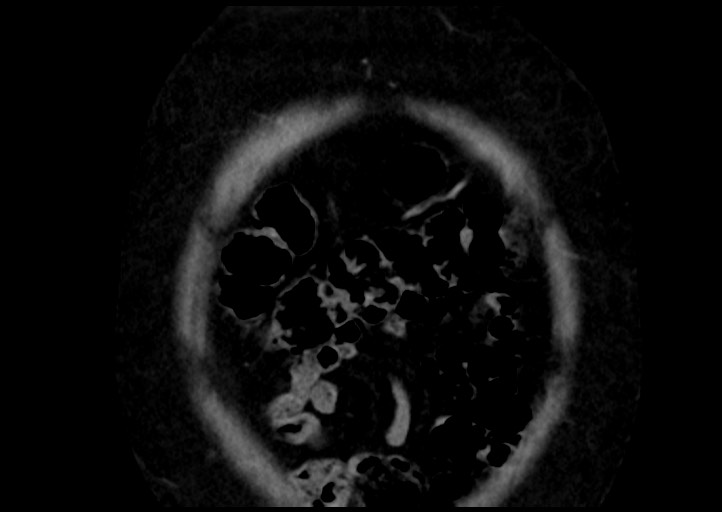 File:Adrenal cortical carcinoma (Radiopaedia 64017-72769 Coronal C+ portal venous phase 5).jpg