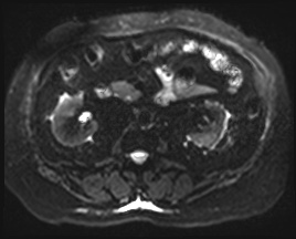 Adrenal cortical carcinoma (Radiopaedia 64017-72770 Axial DWI 26).jpg