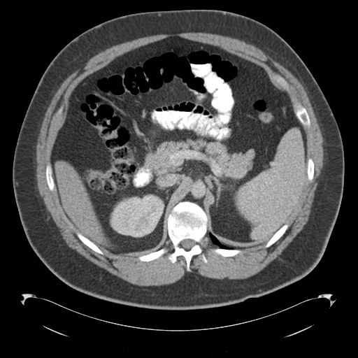 Adrenal cyst (Radiopaedia 45625-49776 Axial C+ portal venous phase 33).png