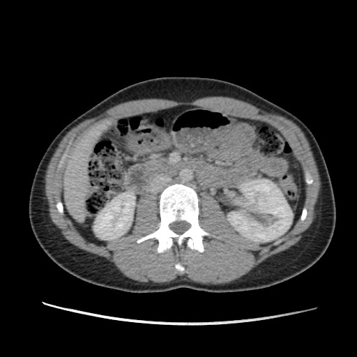 Adrenal cyst (Radiopaedia 64869-73813 Axial C+ portal venous phase 35).jpg