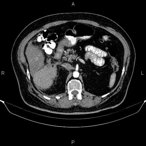 Adrenal hemorrhage (Radiopaedia 62622-70916 Axial C+ arterial phase 138).jpg