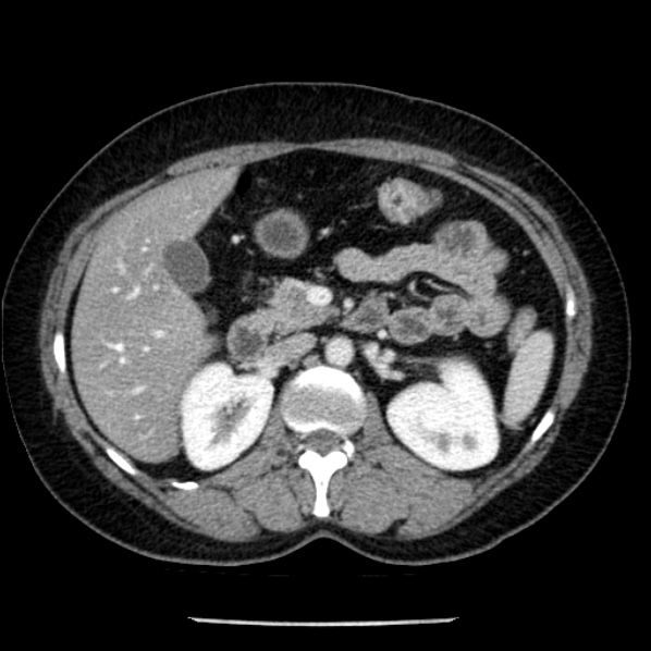 Adrenal myelolipoma (Radiopaedia 43401-46759 Axial C+ portal venous phase 32).jpg