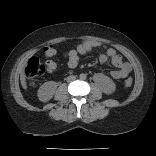 Adrenal myelolipoma (Radiopaedia 43401-46759 Axial non-contrast 46).jpg