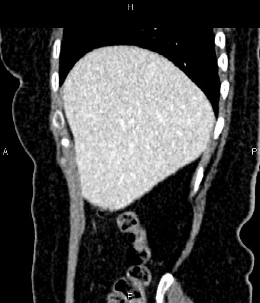 Adrenal myelolipoma (Radiopaedia 82742-96986 Sagittal renal cortical phase 25).jpg