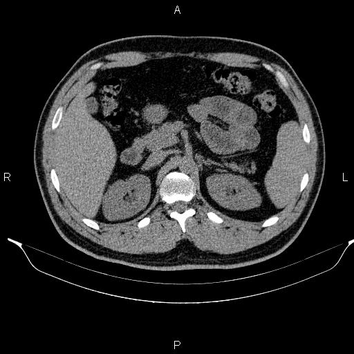 Adrenal myelolipoma (Radiopaedia 84321-99619 Axial non-contrast 39).jpg