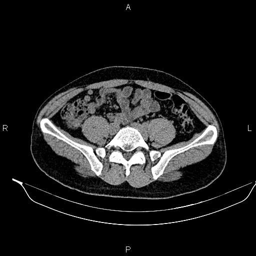 Adrenal myelolipoma (Radiopaedia 87794-104246 Axial non-contrast 74).jpg