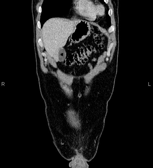 Adrenal myelolipoma (Radiopaedia 87794-104246 Coronal renal cortical phase 7).jpg