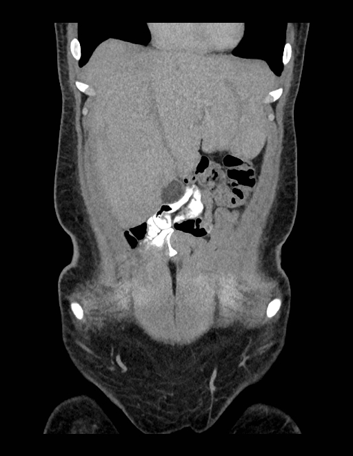 Adrenal myelolipoma - bilateral (Radiopaedia 74805-85810 Coronal C+ portal venous phase 216).jpg