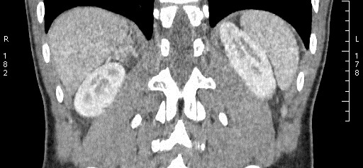 File:Adrenal pheochromocytoma (Radiopaedia 35133-36726 Coronal C+ portal venous phase 3).jpg