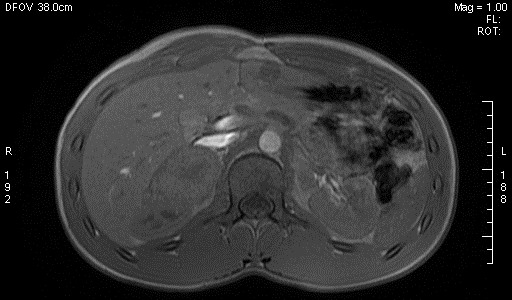 File:Adrenal pheochromocytoma (Radiopaedia 35133-36730 Axial T1 out-of-phase 7).jpg