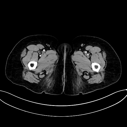 Adrenocortical carcinoma (Radiopaedia 87281-103569 Axial C+ arterial phase 97).jpg