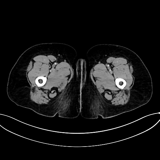 Adrenocortical carcinoma (Radiopaedia 87281-103569 Axial C+ portal venous phase 98).jpg