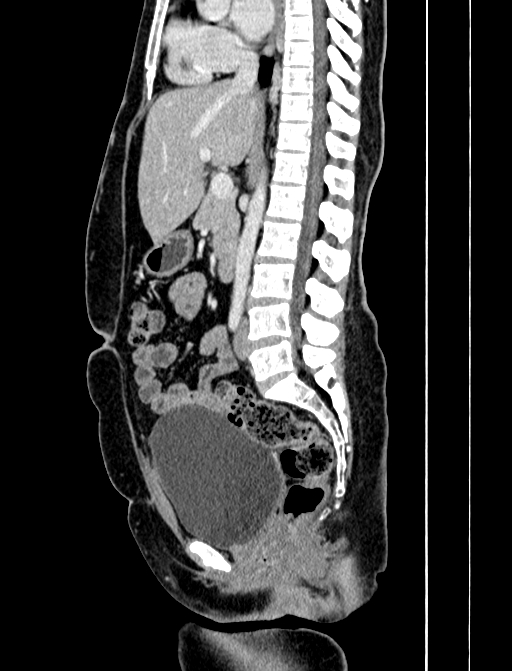 Adrenocortical carcinoma (Radiopaedia 87281-103569 Sagittal C+ portal venous phase 148).jpg