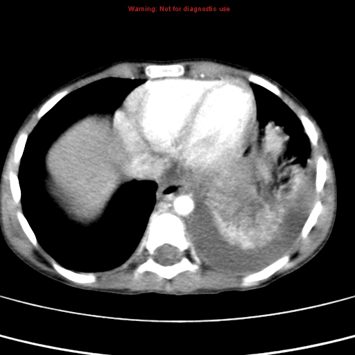 File:Adrenocortical carcinoma (Radiopaedia 9449-10131 Axial C+ portal venous phase 4).jpg