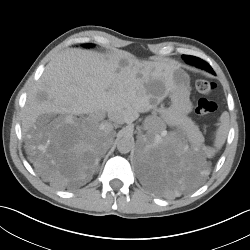 File:Adult polycystic kidney disease (Radiopaedia 47866-52626 Axial non-contrast 16).png