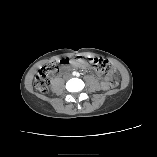 File:Adult polycystic kidney disease (Radiopaedia 48845-53876 Axial renal cortical phase 45).jpg