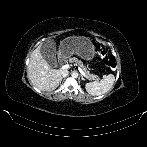 File:Afferent loop syndrome - secondary to incarcerated trocar site hernia (Radiopaedia 82959-97305 Axial C+ portal venous phase 69).jpg