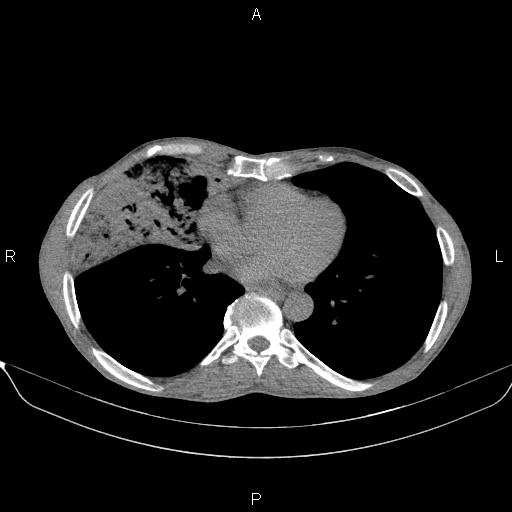 Air bronchogram in pneumonia (Radiopaedia 85719-101512 Axial non-contrast 43).jpg
