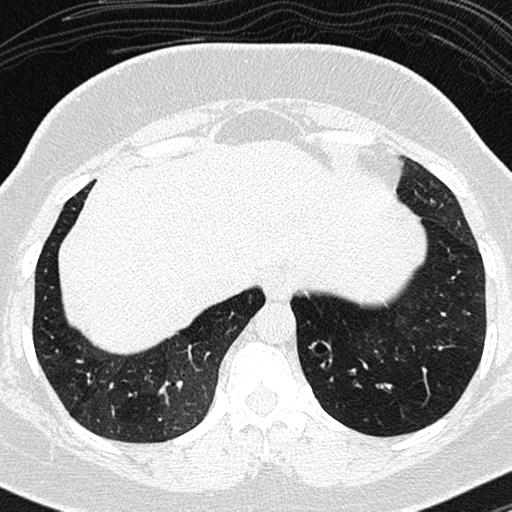 Air trapping in small airway disease (Radiopaedia 61685-69694 Axial lung window 157).jpg
