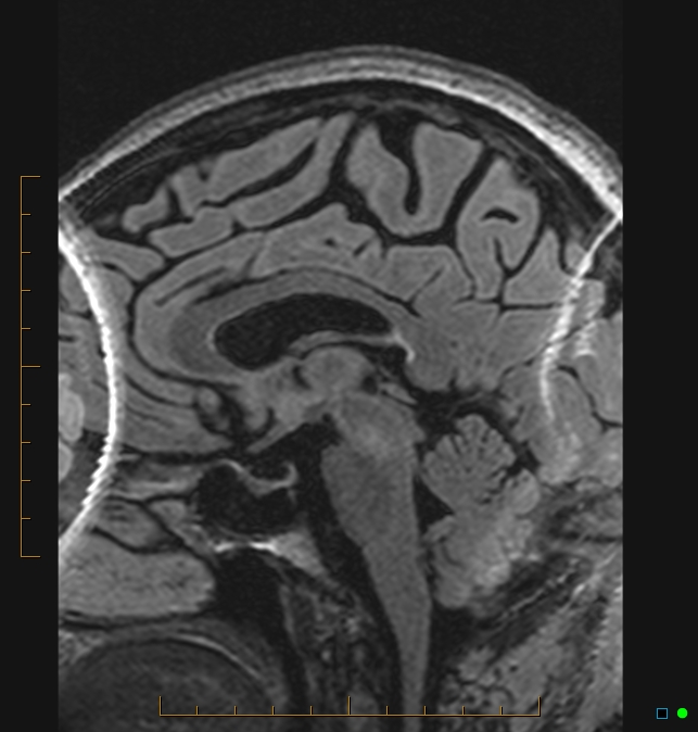 Aliasing artifact causing a spurious cerebellar lesion (Radiopaedia 48783-53810 Sagittal FLAIR 41).jpg