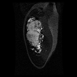 Alveolar soft part sarcoma (Radiopaedia 64501-73678 D 113).jpg