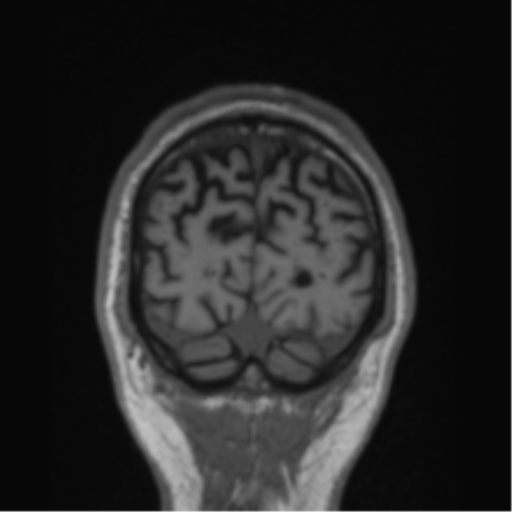 File:Alzheimer's disease- with Gerstmann syndrome and dressing apraxia (Radiopaedia 54882-61150 Coronal T1 12).png