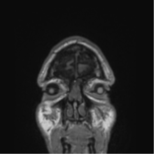 File:Alzheimer's disease- with Gerstmann syndrome and dressing apraxia (Radiopaedia 54882-61150 Coronal T1 87).png